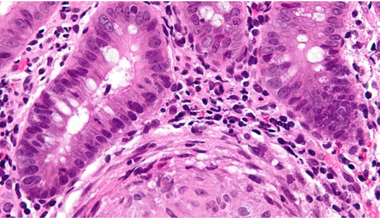 crohn tedavisinde yeni bulgular