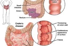 Photo of Crohn Hastalığında Güncel Tedaviler – 2023