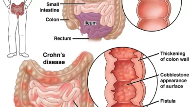 Photo of Yeni Alman Tıbbı’na Göre Crohn Hastalığı